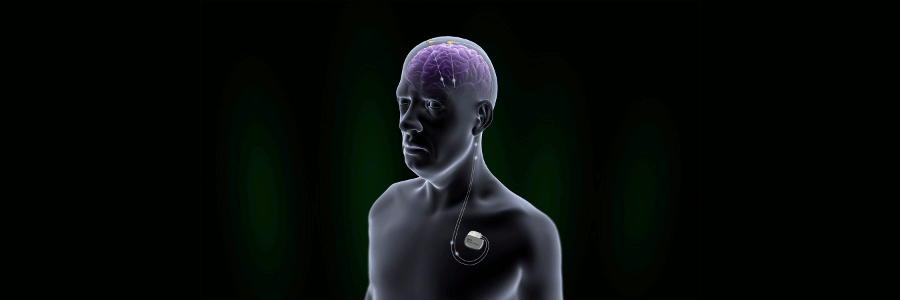 אלקטרודה לגירוי תוך מוחי